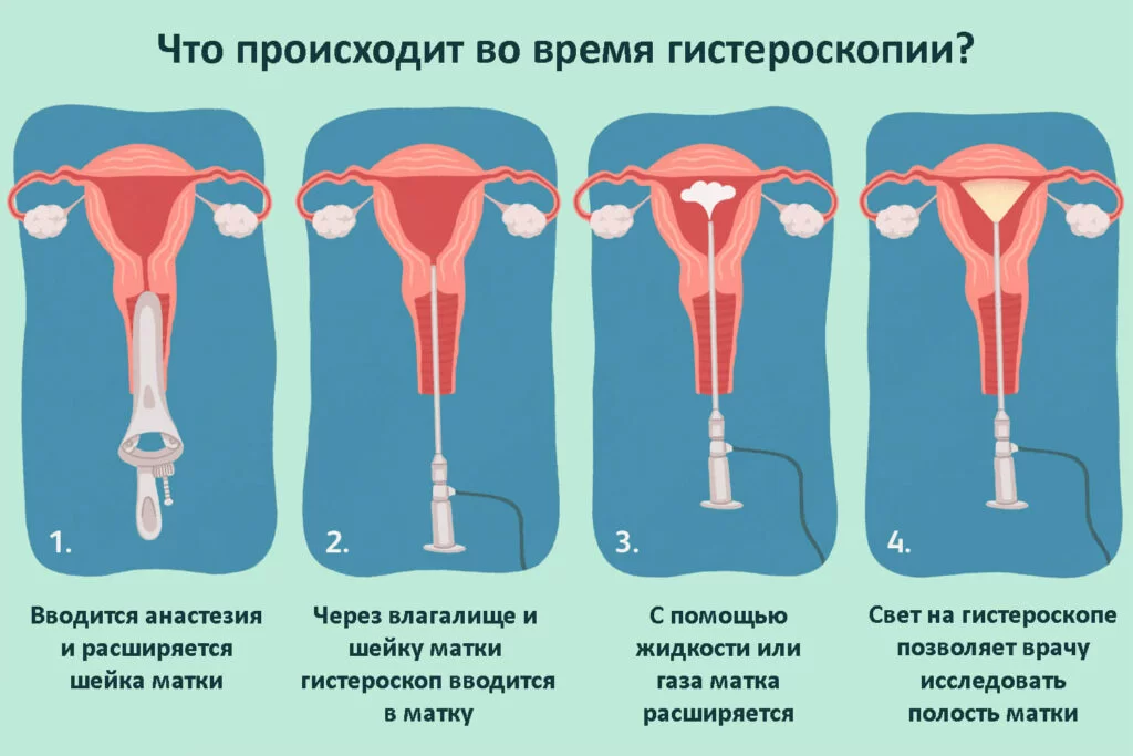 Как проводят гистероскопию в Харькове